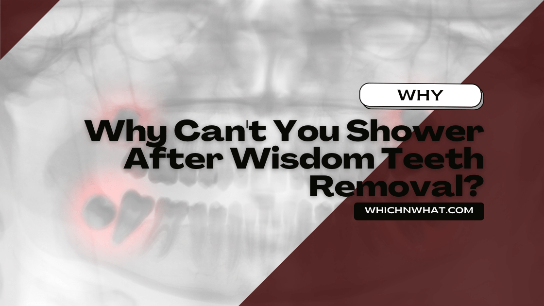 Why Can’t You Shower After Wisdom Teeth Removal?
